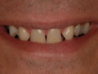 Before Smile - Ten porcelain veneers to be fitted