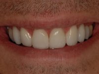 After Smile - Ten porcelain veneers fitted