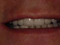 After smile - Orthodontics, dental implants, veneers & teeth whitening