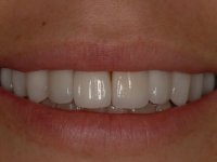 After smile - Porcelain veneers and teeth whitening