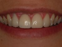 After smile - 3 veneers and a dental crown