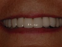 After smile - dental bridges and crowns