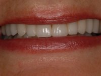 After smile - Porcelain veneers