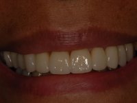 After smile - Porcelain veneers & dental crowns