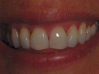 After smile - Clearstep orthodontics