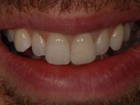 After smile - Professional tooth whitening and a white front tooth restoration filling