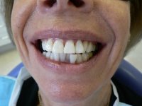 After smile - Professional teeth whitening
