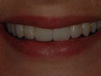 After smile - Veneers