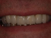 After smile - Several dental bridges and crowns