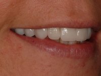 After smile - Porcelain veneers