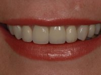 After smile - a mixture of dental crowns and veneers fitted