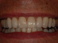 After smile - porcelain veneers fitted