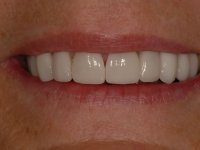 After smile - Orthodontics followed by ten porcelain veneers