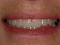 After smile - porcelain veneers