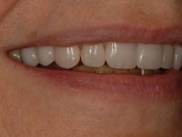 After smile - 10 porcelain veneers & lower teeth whitening