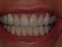 After smile - upper and lower porcelain veneers