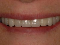 After smile - Porcelain veneers and teeth whitening