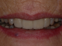After 4 veneers