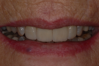 After 4 veneers