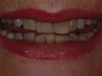 Before 4 Veneers