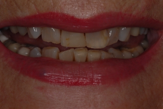 Before 4 Veneers