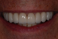 After Replacement Venners