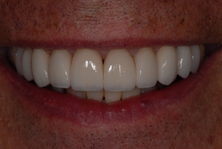 After Replacement Venners