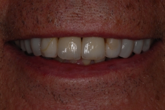 Before Replacement Veneers