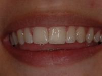 After Composite Bonding