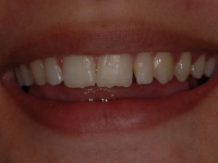 Before Composite Bonding