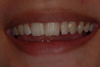 Before Composite Bonding