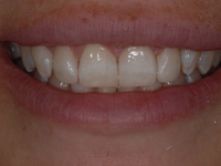After Fastbraces