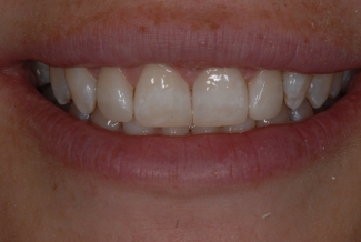 After Fastbraces