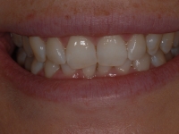 Before Fastbraces
