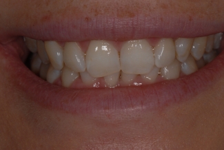 Before Fastbraces