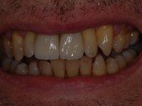 After Implants