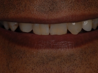 After Implants