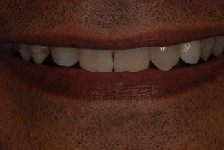 After Implants