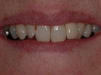 After Implants