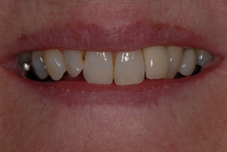 After Implants