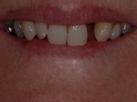 Before Implants