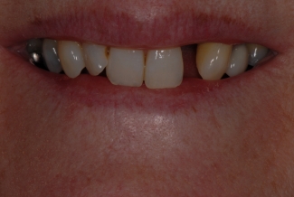 Before Implants