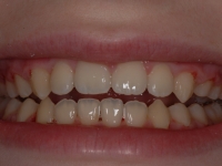 After Fastbraces