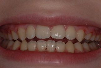 After Fastbraces