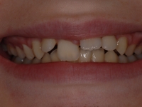 Before Fastbraces