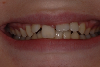 Before Fastbraces