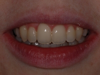 After Fastbraces