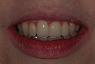 After Fastbraces