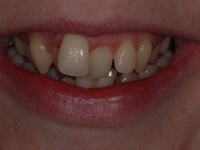 Before Fastbraces