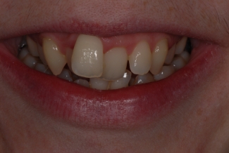 Before Fastbraces